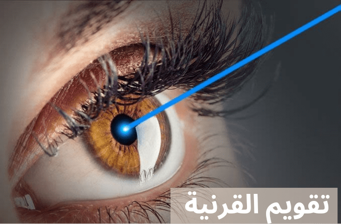 تقويم القرنية