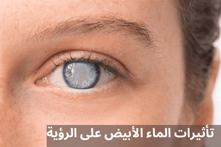 تأثير الماء الأبيض على الرؤية