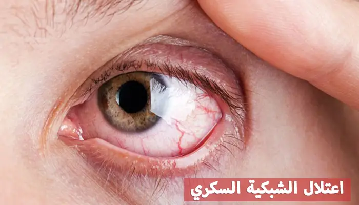 اعتلال الشبكية السكري - نظرة عامة