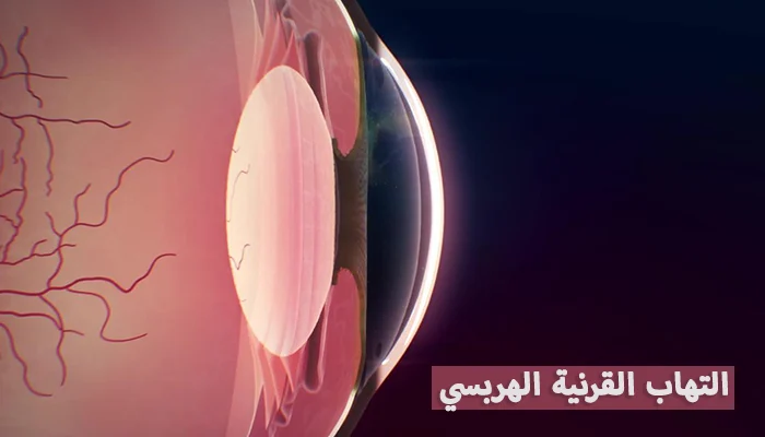 ما هو التهاب القرنية الهربسي؟