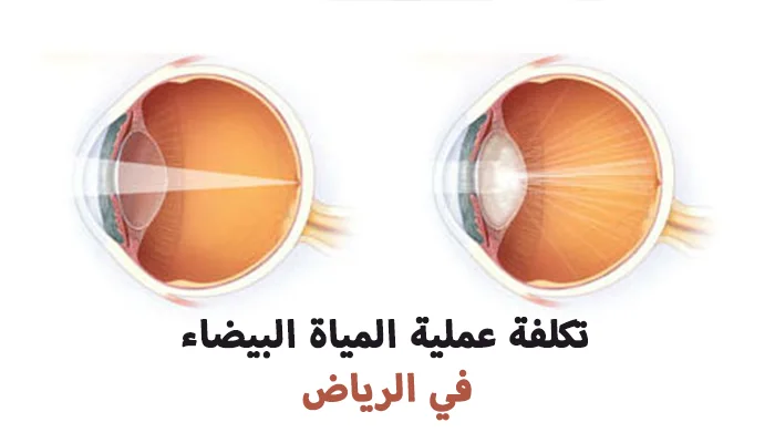 تكلفة عملية المياه البيضاء في الرياض
