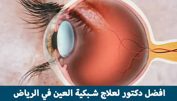 افضل دكتور لعلاج شبكية العين في الرياض
