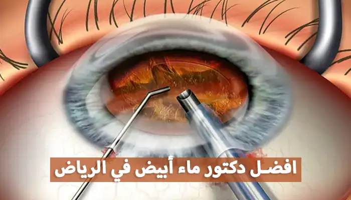 افضل دكتور ماء أبيض في الرياض