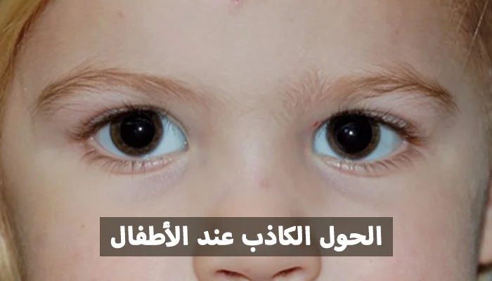 الحول من المشكلات التي تُقلق الوالدين بشكل كبير، ما يدفعهم للتوجه إلى طبيب العيون فورًا لفحص حالة الطفل. يوضح الدكتور محمد العمرو أن هناك أنواعًا مختلفة من الحول، أحدها ما يُعرف بالحول الكاذب. واليوم سنتناول بالتفصيل عن الحول الكاذب عند الأطفال وأسبابه وكيفية علاجه.

يفسر الدكتور محمد العمرو -استشاري طب وجراحة العيون - الحول الكاذب بأنه حالة يظهر فيها انحراف في إحدى العينين، بينما تكون العينان في الواقع بمحاذاة طبيعية. هذه الحالة غالبًا ما تثير مخاوف الأبوين من إصابة طفلهما بحول حقيقي.