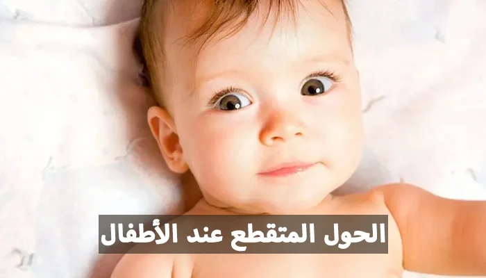 الحول المتقطع عند الأطفال أنواعه وأبرز أعراضه