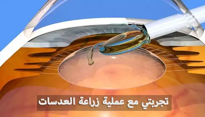 تجربتي مع عملية زراعة العدسات