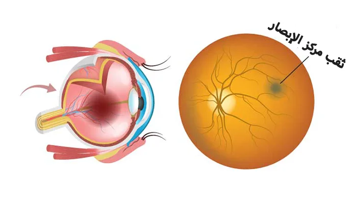 علاج ثقب مركز الإبصار