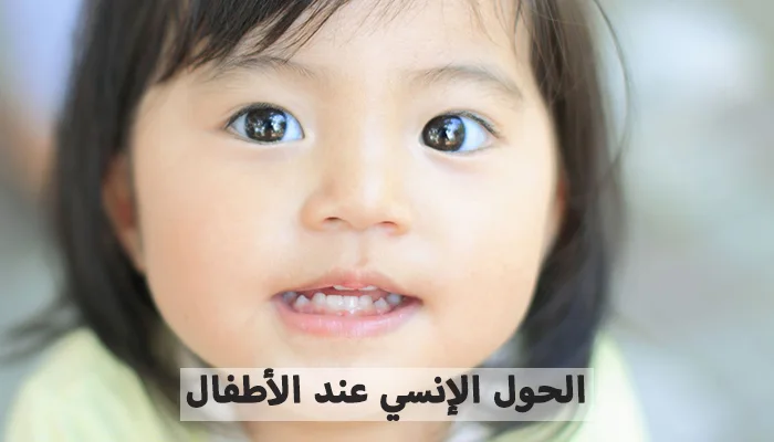 أسباب وعلاج الحول الإنسي عند الأطفال
