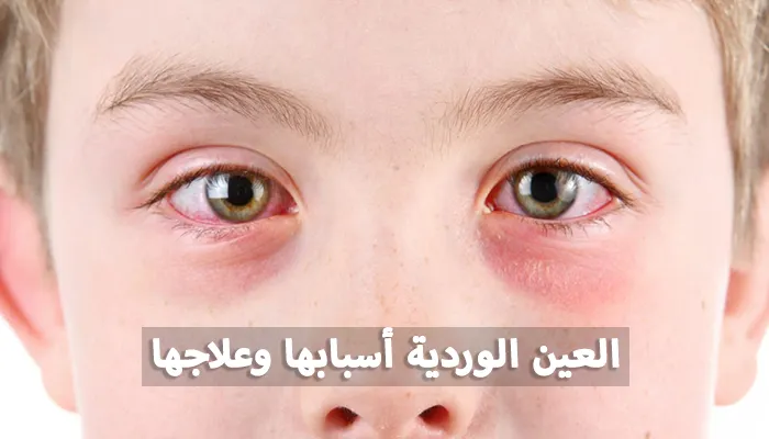العين الوردية أسبابها، أعراضها، وطرق الوقاية والعلاج