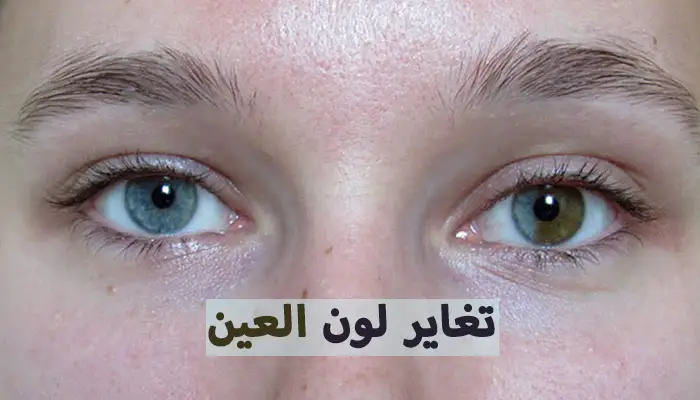 تغاير لون العين: الأسباب، الأنواع، والعلاج