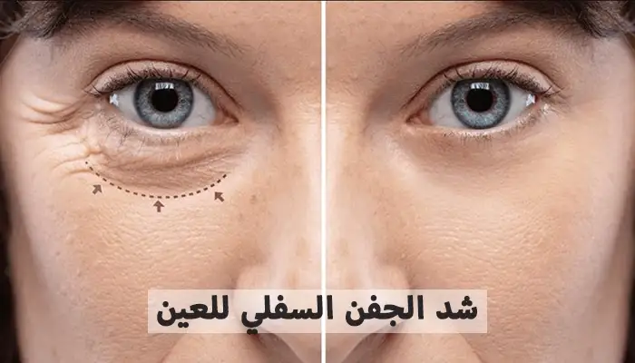 شد الجفن السفلي للعين كل ما تحتاج معرفته