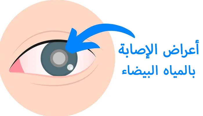 ما أعراض الإصابة بالمياه البيضاء على العين؟