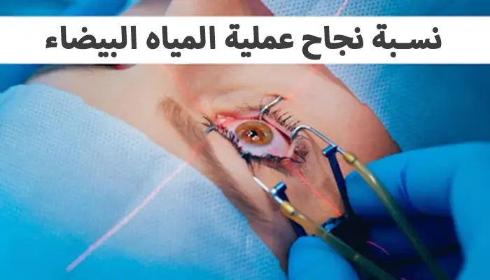 نسبة نجاح عملية المياه البيضاء – التفاصيل الكاملة
