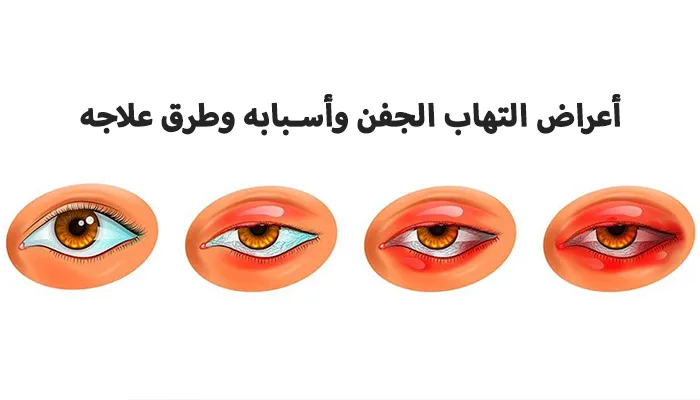 أعراض التهاب الجفن وأسبابه وطرق علاجه