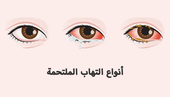 أنواع التهاب الملتحمة: الأسباب، الأنواع، مع نصائح طبية شاملة