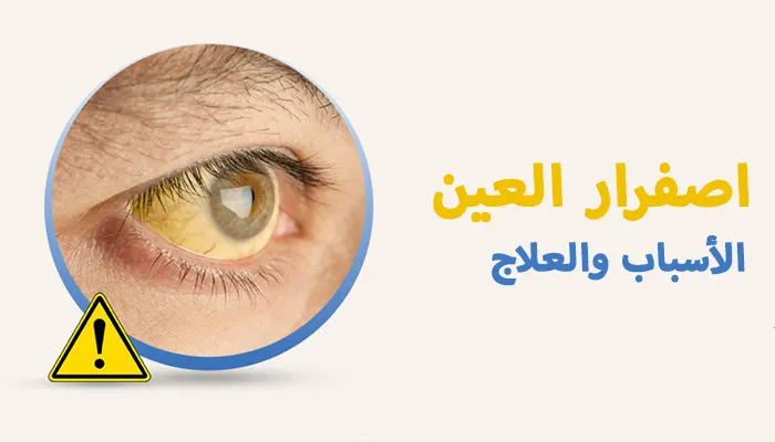 اصفرار العين الأسباب والعلاج