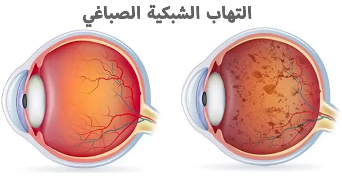 التهاب الشبكية الصباغي الأسباب الأعراض والعلاجات المتاحة