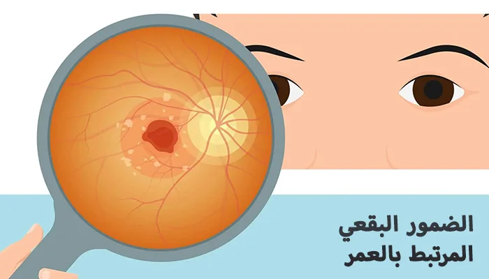 الضمور البقعي المرتبط بالعمر