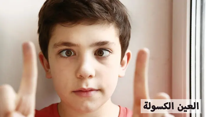 العين الكسولة: الأسباب، الأعراض والعلاجات الفعّالة