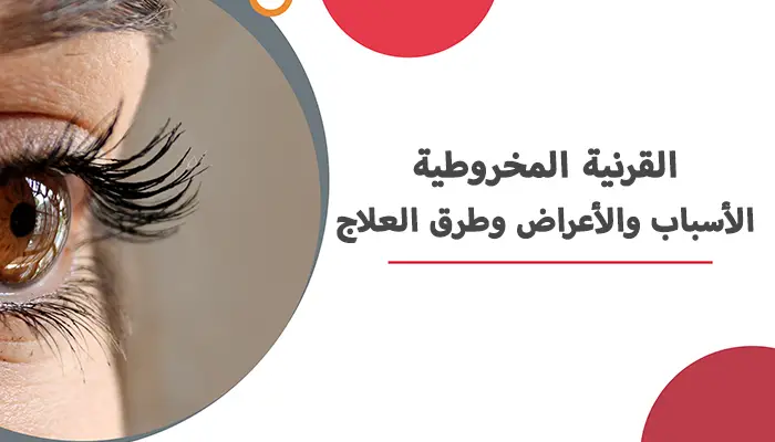 القرنية المخروطية الأسباب والأعراض وطرق العلاج
