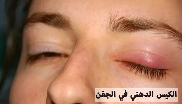 الكيس الدهني في الجفن الأعراض، العوامل المسببة، والعلاج