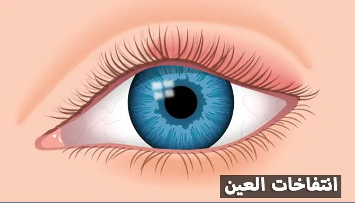 انتفاخات العين: أسبابها وطرق علاجها مع د-محمد العمرو