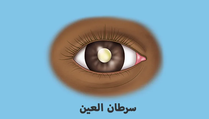 سرطان العين: التشخيص المبكر وخيارات العلاج المتقدمة