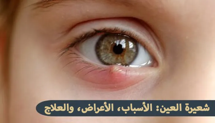 شعيرة العين: الأسباب، الأعراض، والعلاج