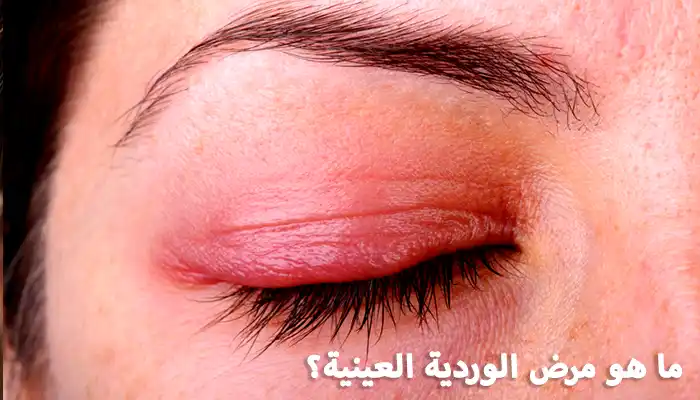 ما هو مرض الوردية العينية؟