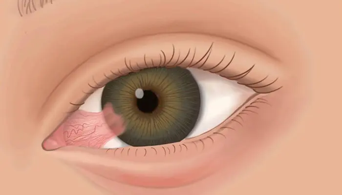 ماهي الزوائد اللحمية في العين؟