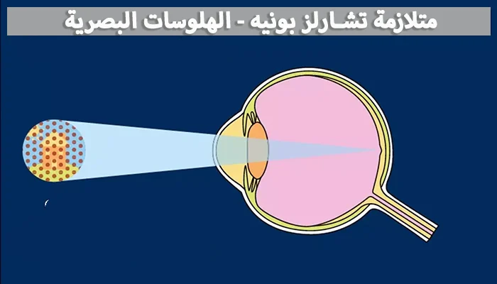 متلازمة تشارلز بونيه - الهلوسات البصرية