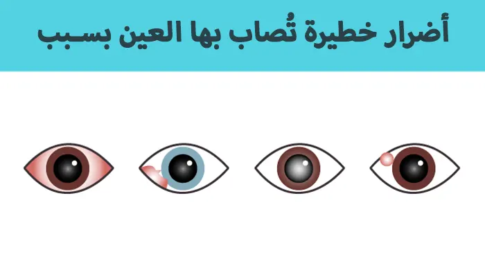 5 أضرار خطيرة تُصاب بها العين بسبب أشعة الشمس