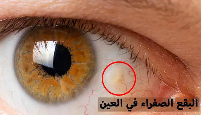 أسباب البقع الصفراء في العين - دكتور محمد العمرو