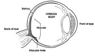 أسباب حدوث الثقب البقعي