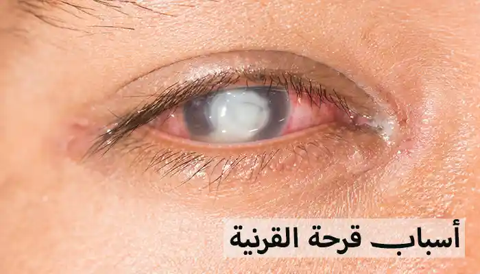 أسباب قرحة القرنية مع أحدث طرق العلاج