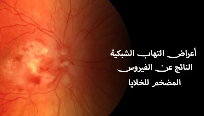 أعراض التهاب الشبكية الناتج عن الفيروس المضخم للخلايا