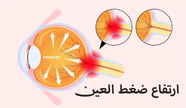 ارتفاع ضغط العين: 5 أسباب لارتفاع ضغط العين