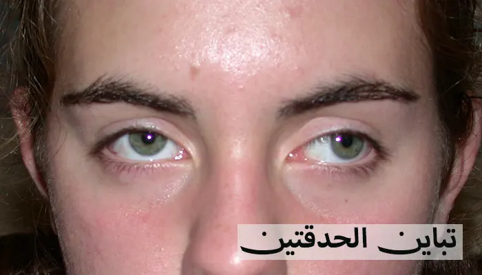 تباين الحدقتين الأسباب والعلاج وفقًا لأحدث التوصيات