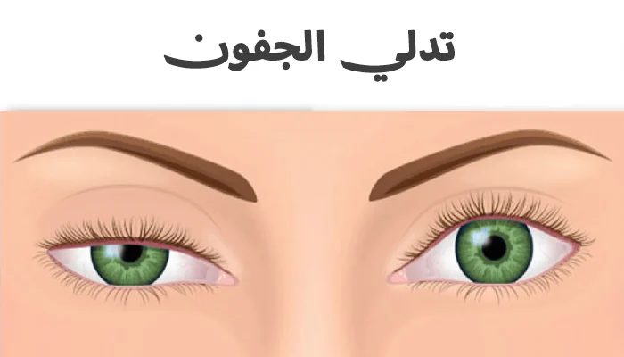 تدلي الجفون (ارتخاء الجفون) الأسباب والعلاج