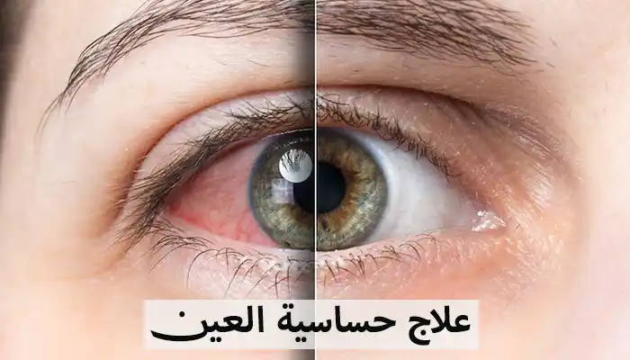 حساسية العين: تخلص من الحكة والدموع في عينيك