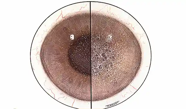 ضمور القرنية فوكس: 7 أشياء يجب أن تعرفها