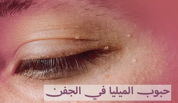 ما هي حبوب الميليا في الجفن وكيفية علاجها