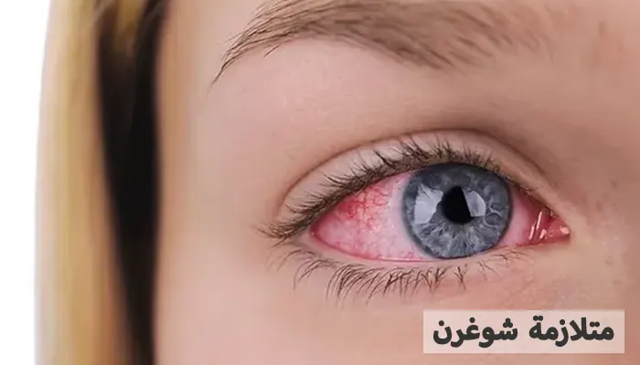 متلازمة شوغرن أسبابه، أعراضه، والتشخيص والعلاج