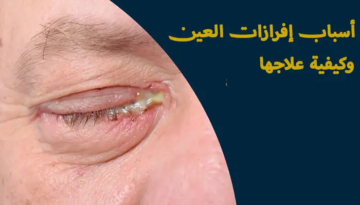 أسباب إفرازات العين وكيفية علاجها