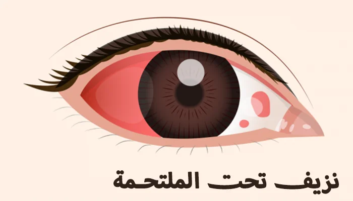 أسباب وعلاج نزيف تحت الملتحمة (دم في العين)