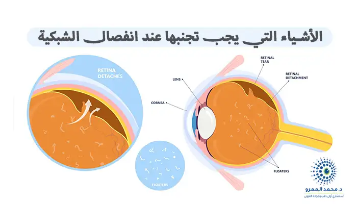 الأشياء التي يجب تجنبها عند انفصال الشبكية