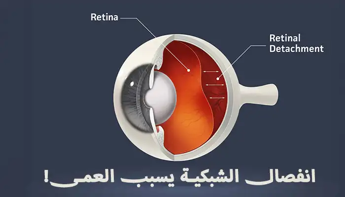 علاج انفصال الشبكية المبكر يقيك من العمى!