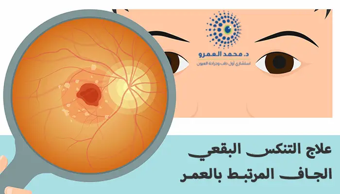 علاج التنكس البقعي الجاف المرتبط بالعمر