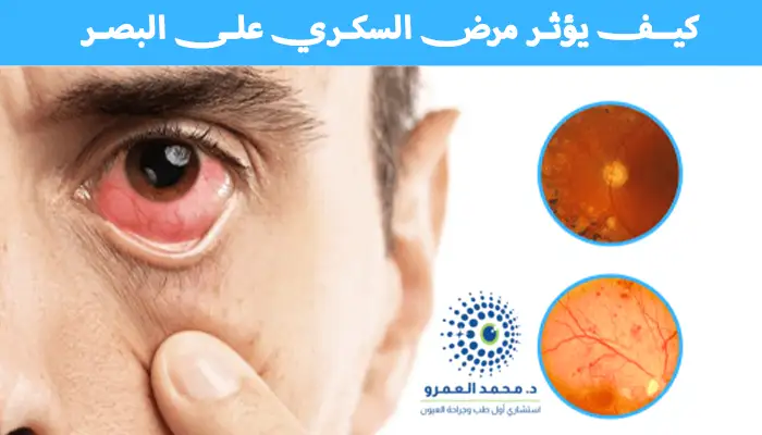 كيف يؤثر مرض السكري على البصر