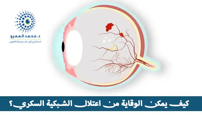 كيف يمكن الوقاية من اعتلال الشبكية السكري؟